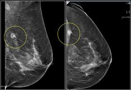 Ciência UFPR: Pandemia prejudicou combate ao câncer de mama no Brasil, avalia estudo